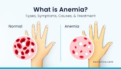 Anemia